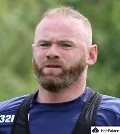 wayne rooney baldness